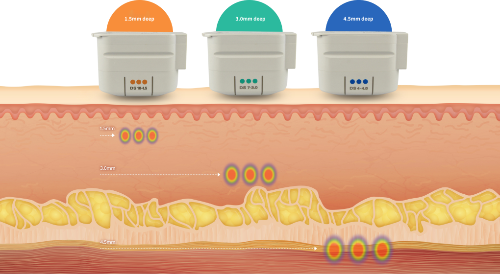 Ulthera laser equipment that lifts the skin.