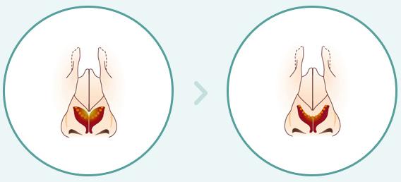 Surgery method of Wide Nose Rhinoplasty Surgery Korea for when the nose tip is wide.