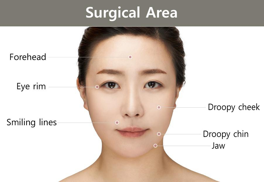 Areas where Thread lifting in Korea is possible.