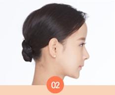 Thread is entered through temple area for Thread lifting in Korea.