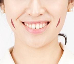 Long dimple style for dimple surgery korea.