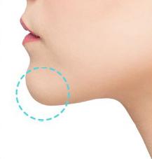 Stem Cell Therapy Korea with fat graft for jaw tip.
