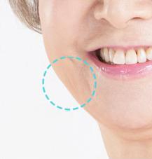 Stem Cell Therapy Korea with fat graft for cheek area.