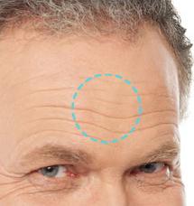 Stem Cell Therapy Korea for forehead wrinkles.