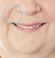 Stem Cell Therapy Korea for smile line wrinkles.