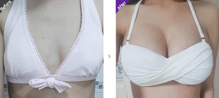 Motiva Breast Implants Surgery Korea before and after 1.