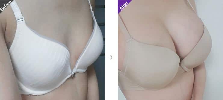 Motiva Breast Implants Surgery Korea before and after 2.