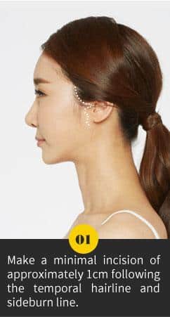 Incision line for Macs Facelift Plastic Surgery In Korea.