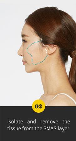 Surgery area of the face for Macs Facelift Plastic Surgery In Korea.
