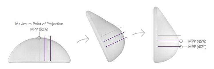 Natural movement of Motiva Breast Implants Surgery Korea.