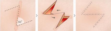 Scar Removal & Revision Surgery Korea zplasty incision.