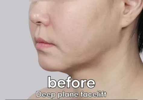 Before deep plane facelift side profile showing mild jawline sagging and early facial laxity, commonly seen when considering the best age for facelift surgery.