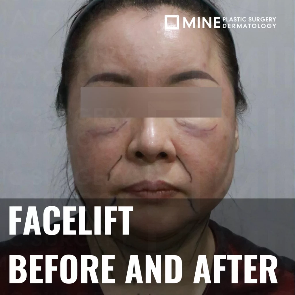 Facelift before and after frontal view of middle-aged woman with surgical markings on cheeks and jawline, showing pre-operative facial sagging and contour planning for facelift procedure at plastic surgery clinic.