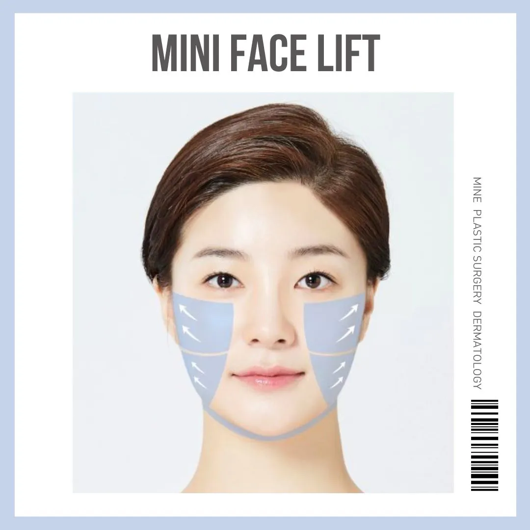 Diagram of the cheek and jawline zones treated in a mini facelift, with arrows showing an upward and outward lift direction