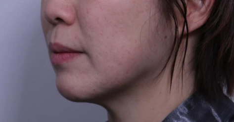 Side profile of an adult woman showing mild skin laxity along the jawline and slight sagging under the chin, illustrating early signs of needing a facelift.