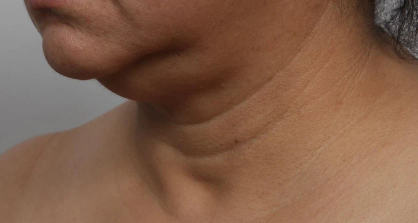 Close-up of the lower face and neck showing skin laxity, double chin fullness, and sagging along the jawline, representing visible signs of needing a facelift.