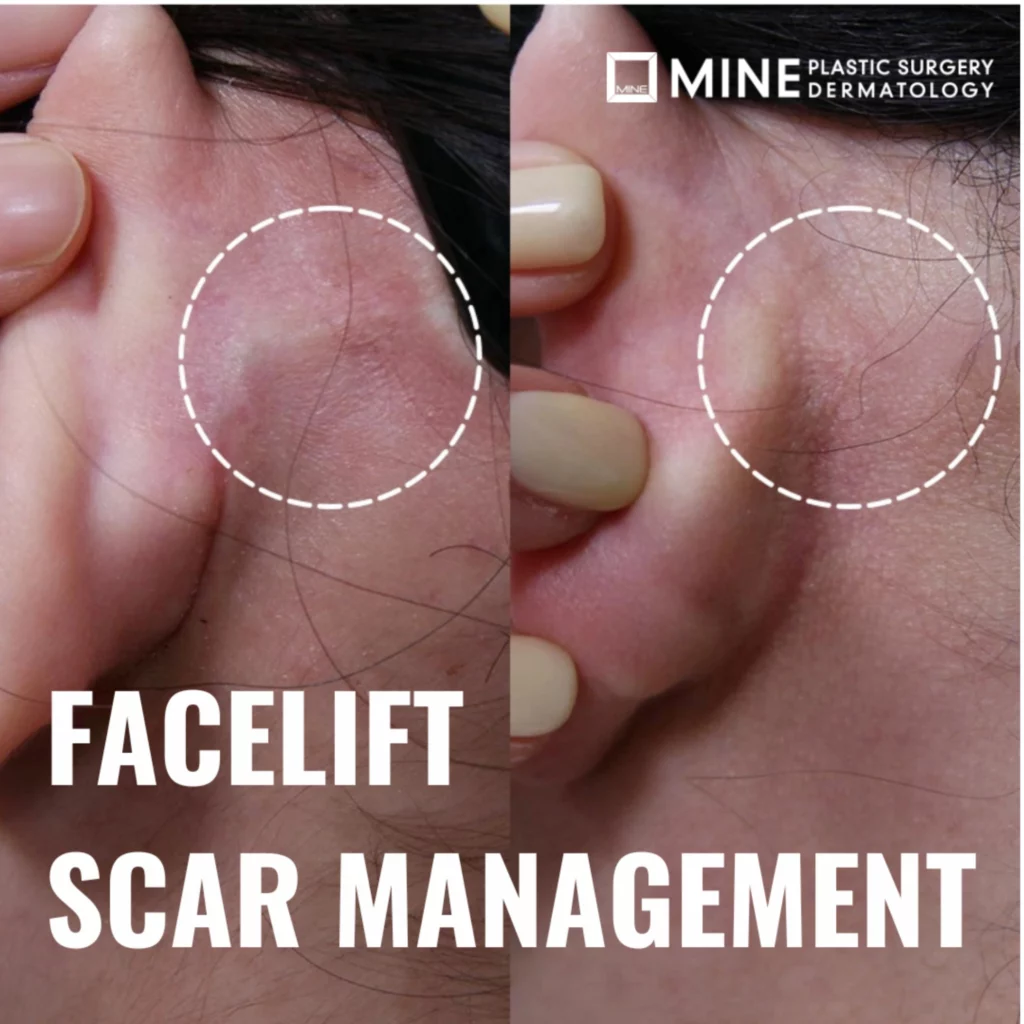 Close-up comparison of incision scars behind the ear demonstrating SMAS facelift scarring and typical healing progression after facelift surgery.