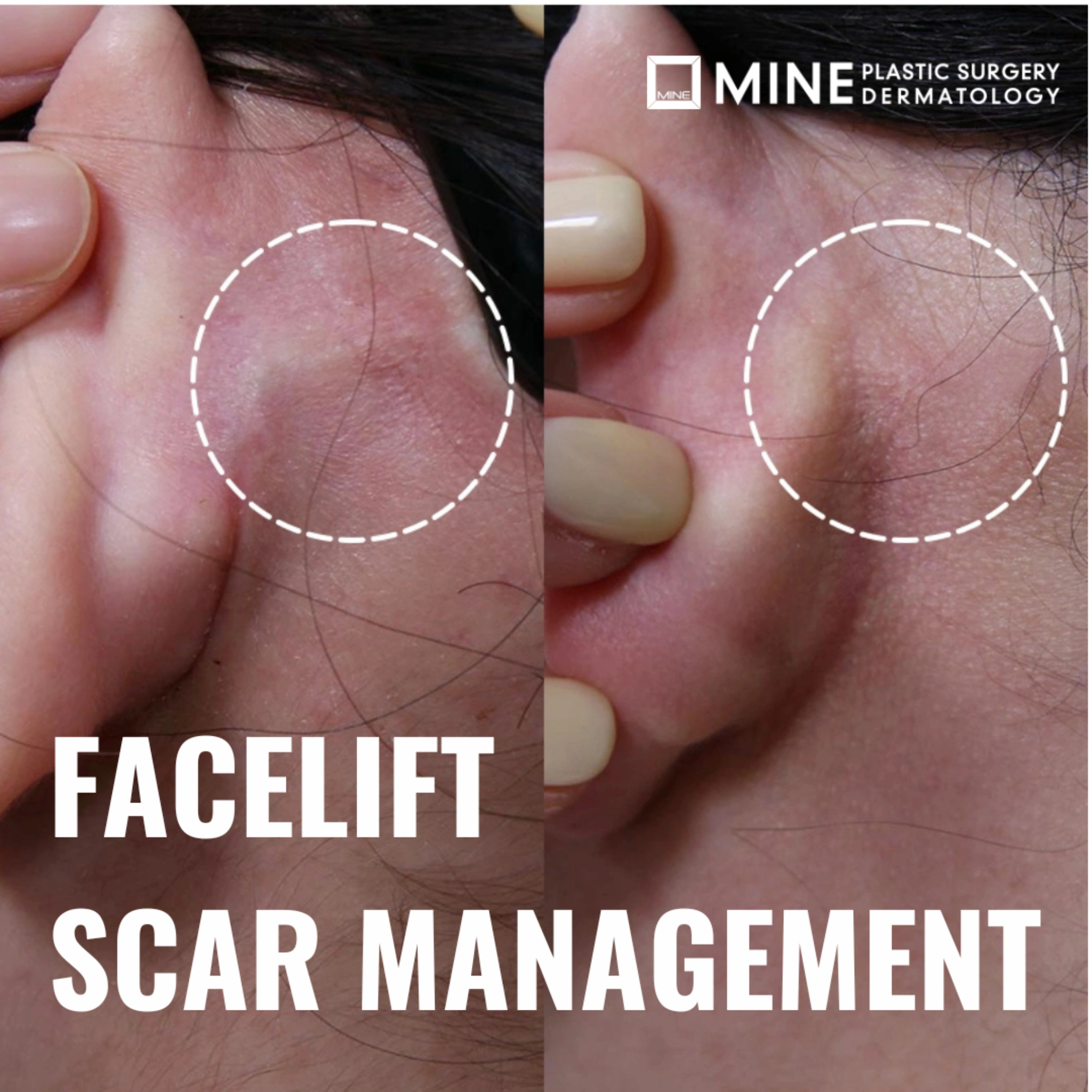 SCAR FACES 新品・未開封 Facelift Scars: 7 Proven Ways to Minimize Them