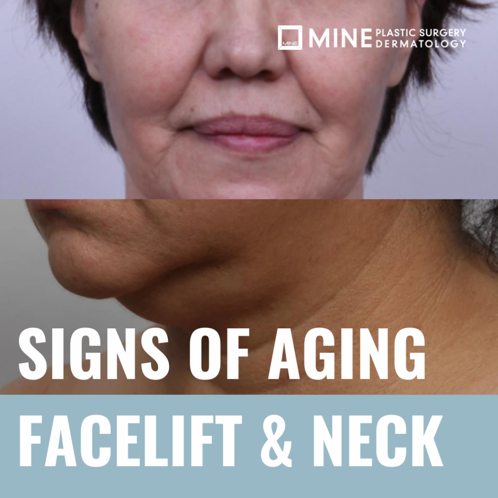 Promotional image showing close-ups of the lower face and neck with visible skin laxity and jawline sagging, labeled as signs of needing a facelift for aging face and neck concerns.