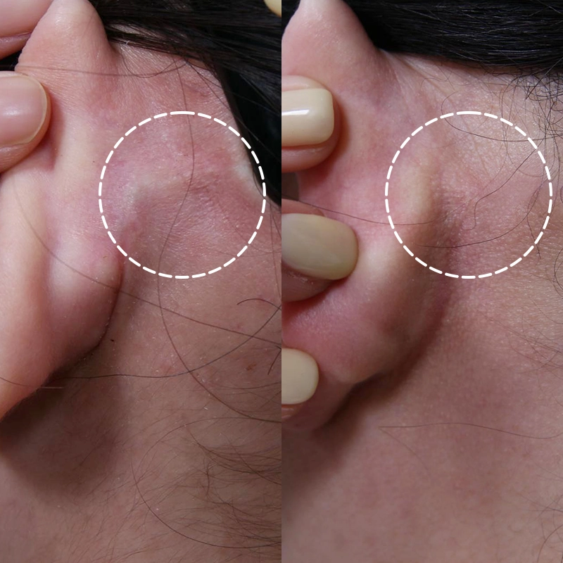 Close-up of incision area behind the ear showing healing scar related to SMAS facelift side effects and post-surgical recovery.