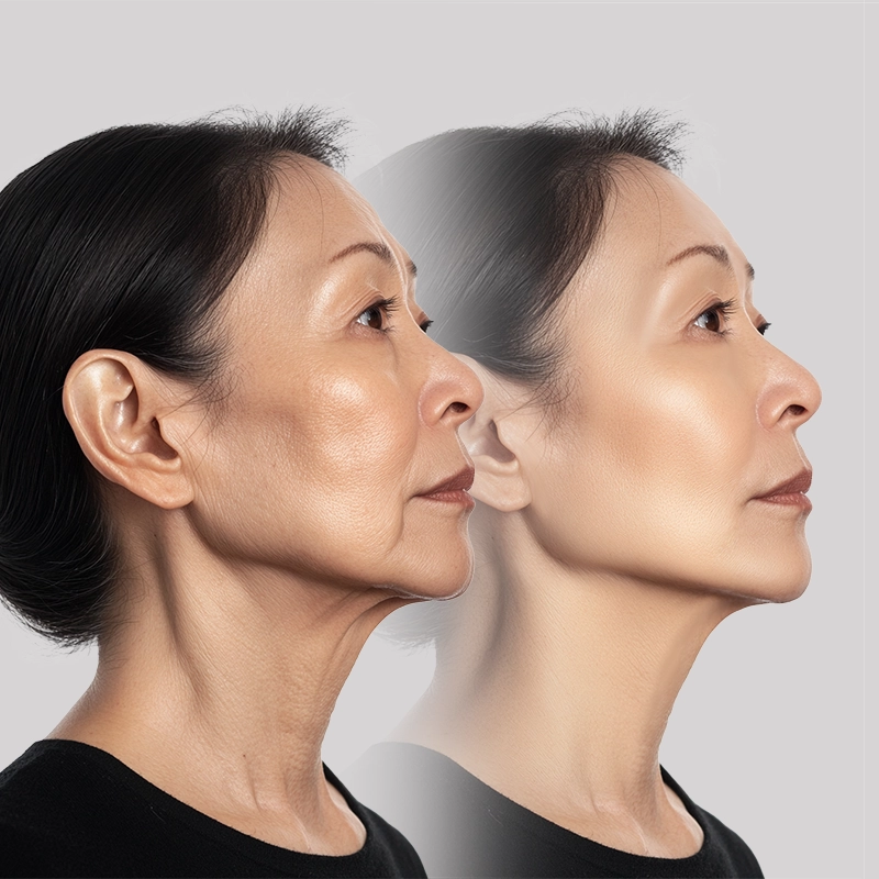 Side profile before and after facelift surgery showing improvement in sagging jawline and neck skin, illustrating potential facelift side effects such as swelling, tightness, and skin texture changes during recovery.