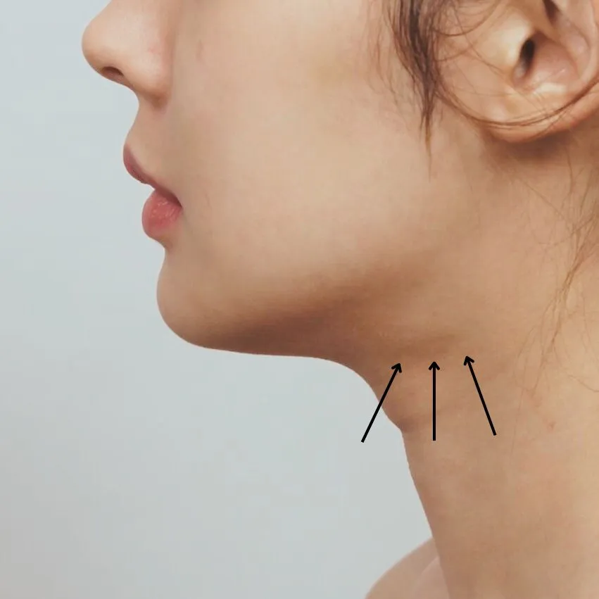 Side profile view showing submandibular and parotid salivary gland botox injection sites marked with arrows for hypersalivation treatment.