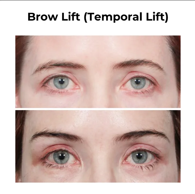 Before and after comparison of a brow lift using the temporal lift facelift method, showing improved eyebrow position and more open eye appearance.