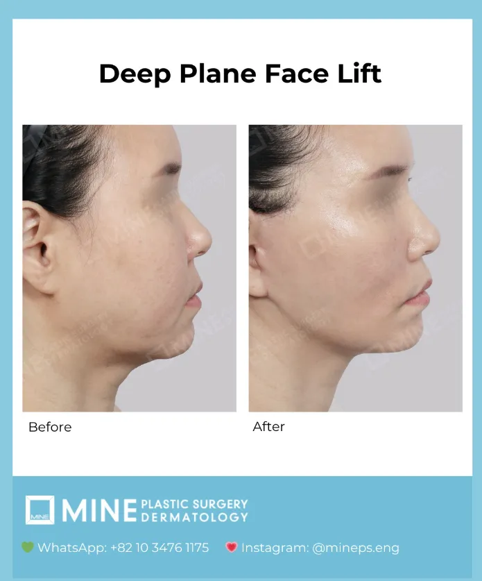 Before and after side profile comparison demonstrating results of a deep plane facelift lifting technique, showing improved jawline definition and reduced lower face sagging.