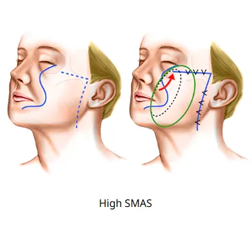 Side-by-side medical illustration demonstrating the high SMAS approach among facelift lifting techniques, showing vector directions for tissue repositioning and enhanced midface support.