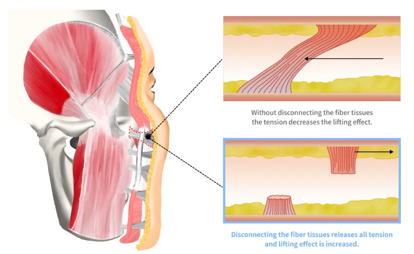 Medical illustration explaining facelift lifting techniques where releasing facial retaining ligaments reduces tension and improves tissue repositioning for a stronger lifting effect.