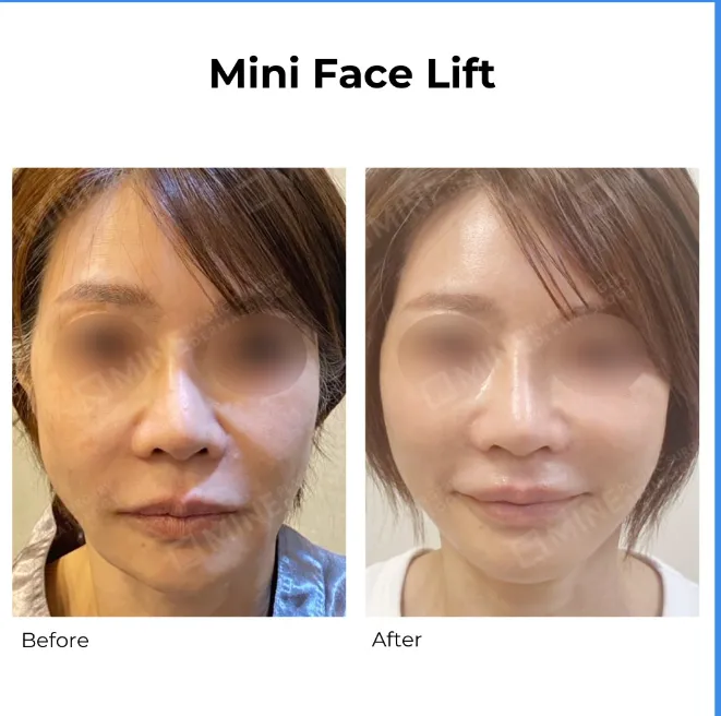 Before and after comparison of a Mini facelift showing improved jawline definition, reduced facial sagging, and a smoother, more lifted lower face appearance.