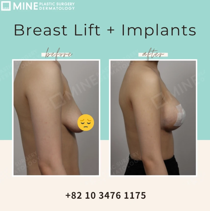 Side-view before and after comparison of breast lift with implants, highlighting breast lift incision placement and improved breast projection and contour.