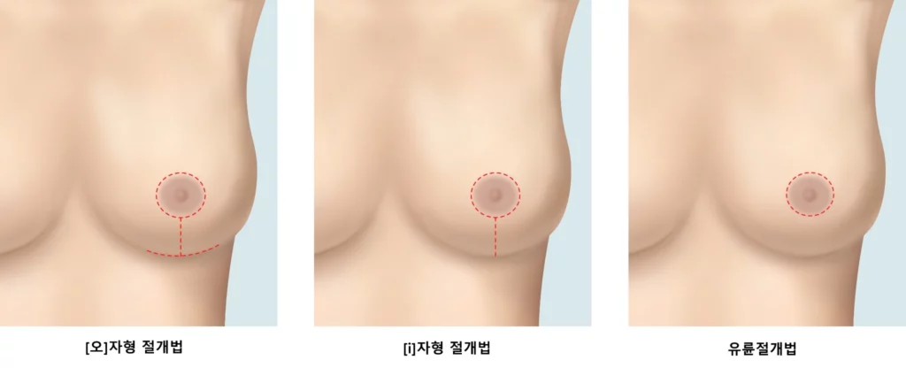 Illustration comparing different breast lift incision techniques, including periareolar, vertical, and lollipop methods, showing nipple repositioning and scar placement in breast lift incision planning.