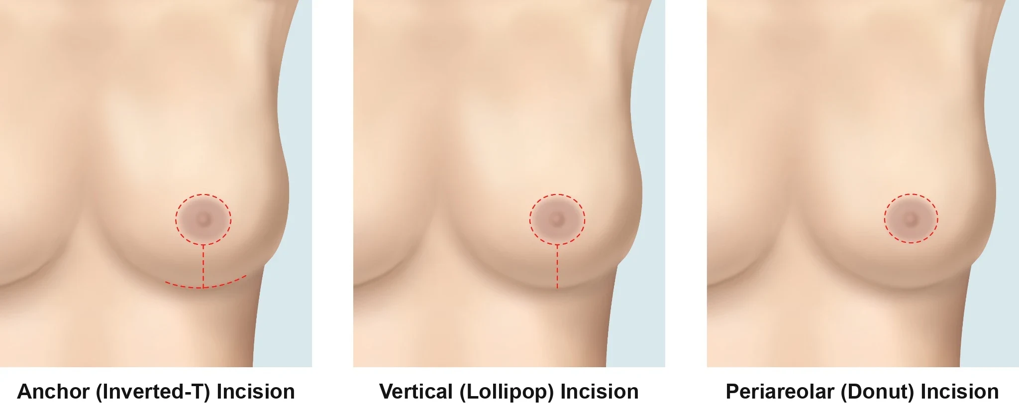 Three breast lift surgery incision types compared: anchor or inverted-T, vertical or lollipop, and periareolar or donut.
