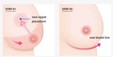 Two-step diagram of breast lift surgery showing the new nipple placement and the new breast line.
