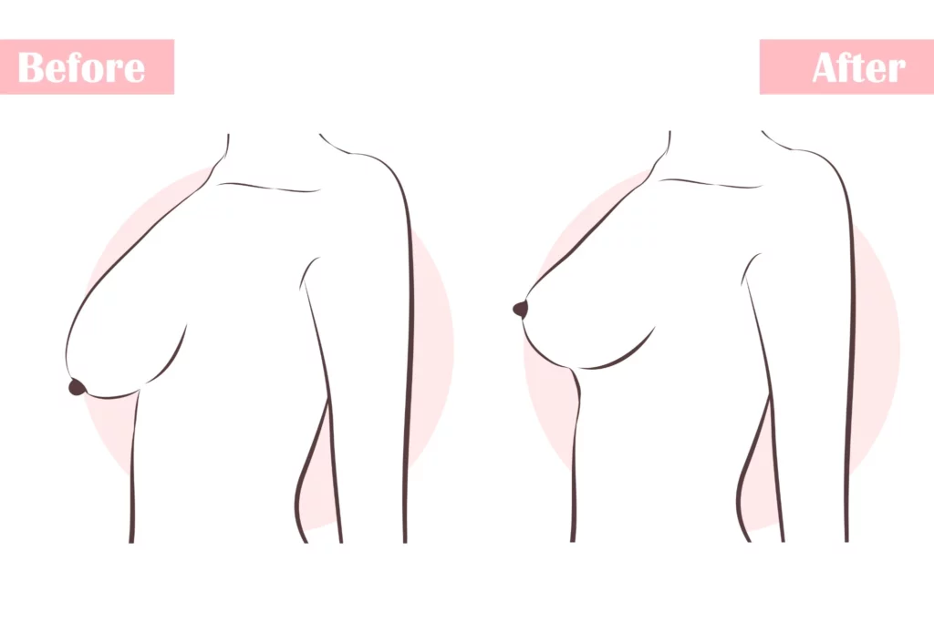 Illustration comparing before and after changes in breast sagging, showing improved breast position and contour following corrective treatment.