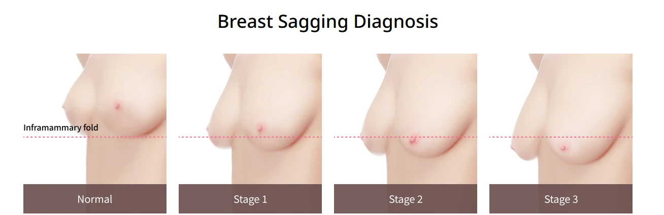 Breast sagging diagnosis chart comparing a normal breast with Grade 1, 2 and 3 ptosis against the inframammary fold, used to plan breast lift surgery.