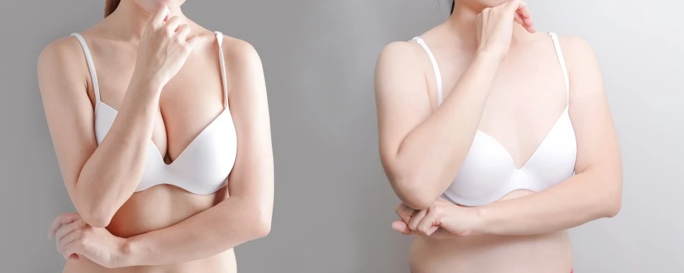 Woman wearing a white bra showing natural body proportions before and after breast augmentation, highlighting changes in upper body balance and contour.