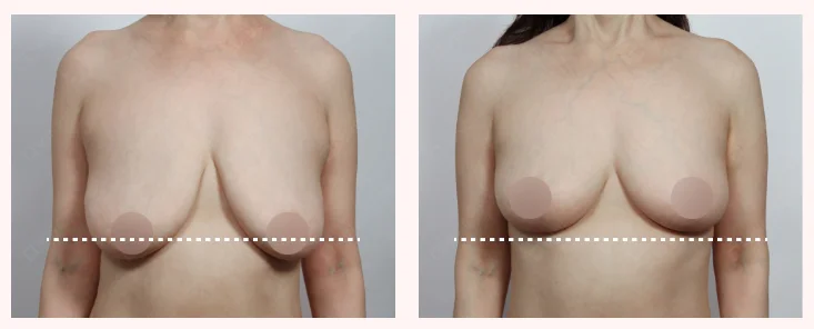 Breast lift with fat transfer before and after comparison showing improved breast height, restored upper pole fullness, and smoother natural breast contour.