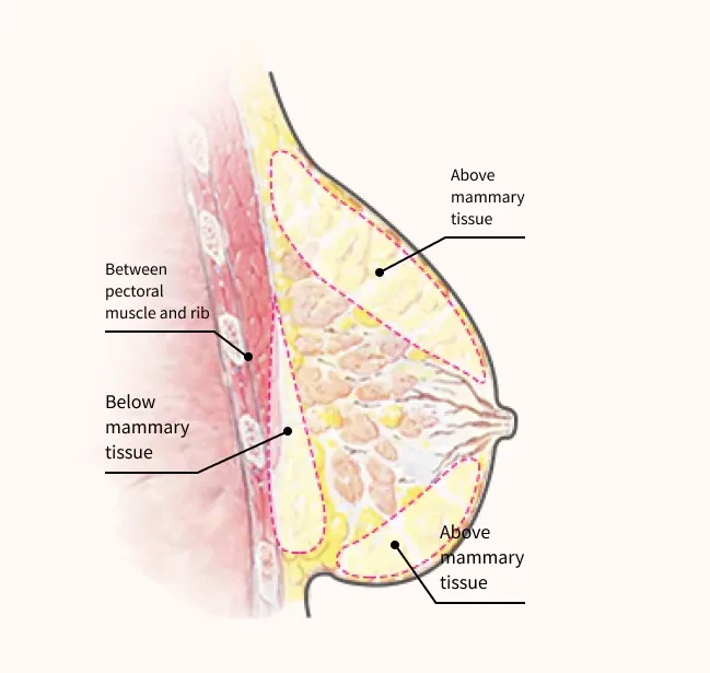 Breast lift with fat transfer diagram showing fat graft placement above and below mammary tissue and between pectoral muscle and rib for natural breast contour enhancement.