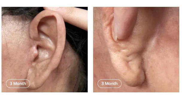 Close-up of ear area showing a well-healed incision line 3 months after facelift surgery, demonstrating minimal visible scarring and natural skin recovery.