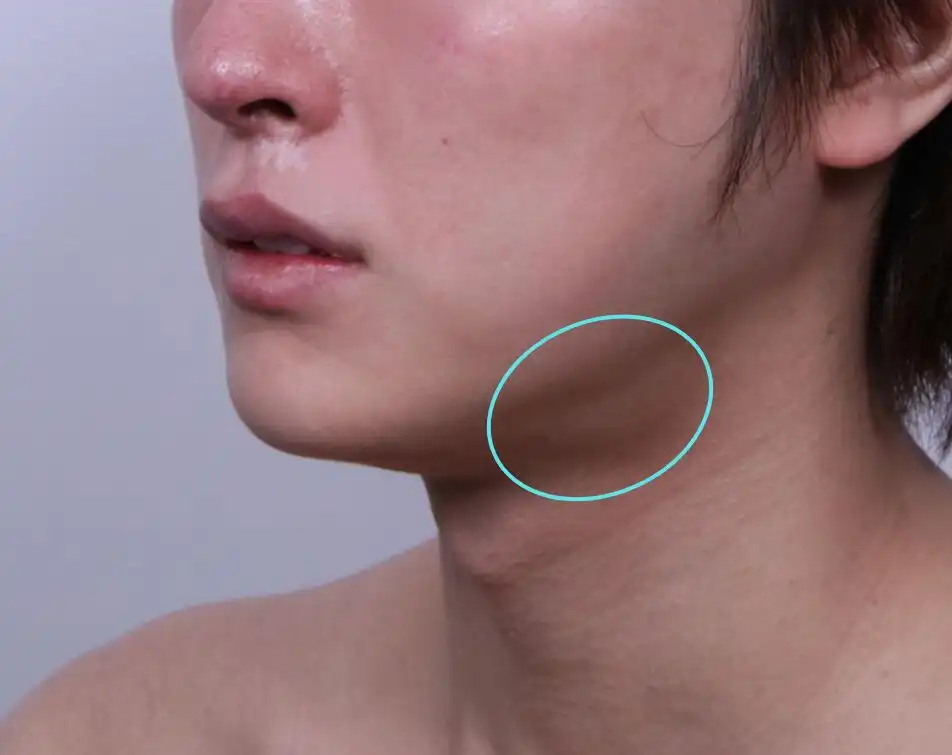 Visible submandibular salivary gland bulge under the jawline, illustrating the target area for salivary gland reduction treatment.