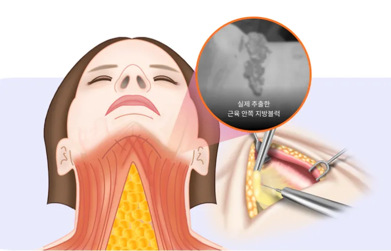Medical illustration showing the anatomy of the submental area and selective removal of deep fat beneath the muscle layer during a double chin removal procedure, highlighting precise surgical fat extraction for jawline contouring.