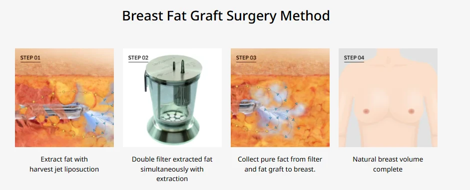 Diagram illustrating the breast fat grafting procedure, including fat harvesting by liposuction, purification through a filtration system, precise fat injection, and completion of natural breast volume.