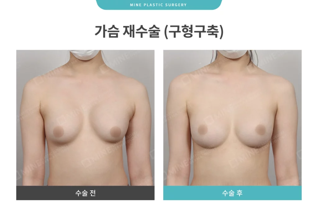 Front view comparison before and after revision surgery related to breast implant rupture, showing improved breast shape and symmetry following corrective breast surgery.