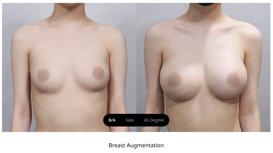 Breast fat grafting vs breast implants before and after comparison showing differences in volume enhancement, contour, and overall breast shape.