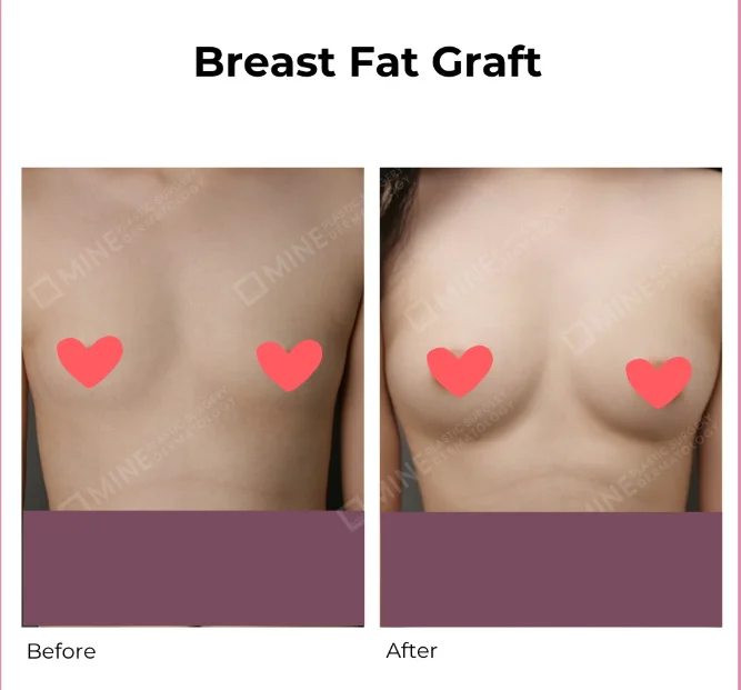Breast fat transfer side effects before and after image showing changes in breast volume and contour following autologous fat grafting, with focus on postoperative outcomes and potential complications.