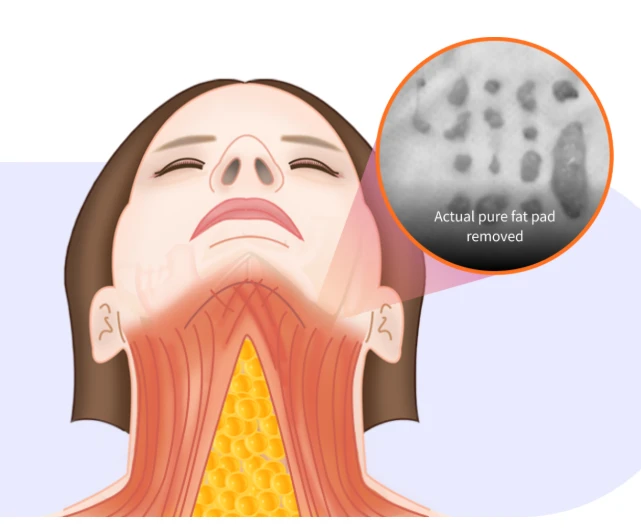 Anatomical illustration showing submental fat removal beneath the chin to explain double chin jawline lifting and improved lower face definition.