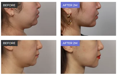 Double chin surgery preparation reference showing before and after 2-month profile views, highlighting jawline definition and contour changes as part of double chin surgery preparation.