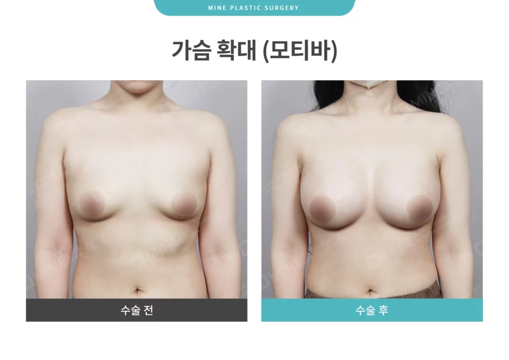 Front view comparison before and after fat transfer breast augmentation, illustrating balanced breast shape and natural fullness achieved with fat grafting.